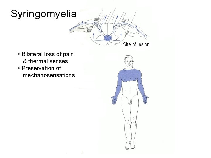 Syringomyelia Site of lesion • Bilateral loss of pain & thermal senses • Preservation