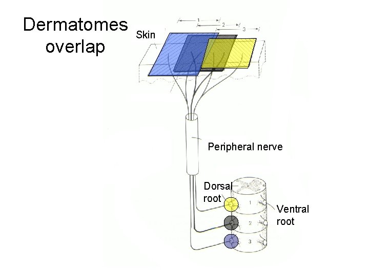 Dermatomes overlap Skin Peripheral nerve Dorsal root Ventral root 