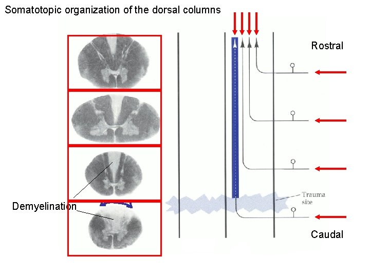 Somatotopic organization of the dorsal columns Rostral Demyelination Caudal 