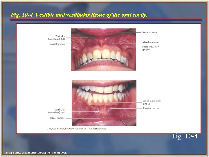 Fig. 10 -4 Vestible and vestibular tissue of the oral cavity. Fig. 10 -4 Fig. 10 -4 Vestible and vestibular tissue of the oral cavity. Fig. 10 -4