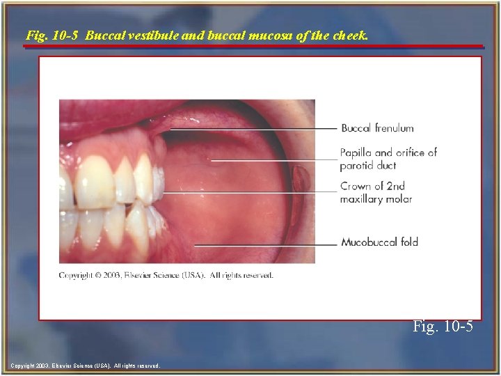 Fig. 10 -5 Buccal vestibule and buccal mucosa of the cheek. Fig. 10 -5 Fig. 10 -5 Buccal vestibule and buccal mucosa of the cheek. Fig. 10 -5
