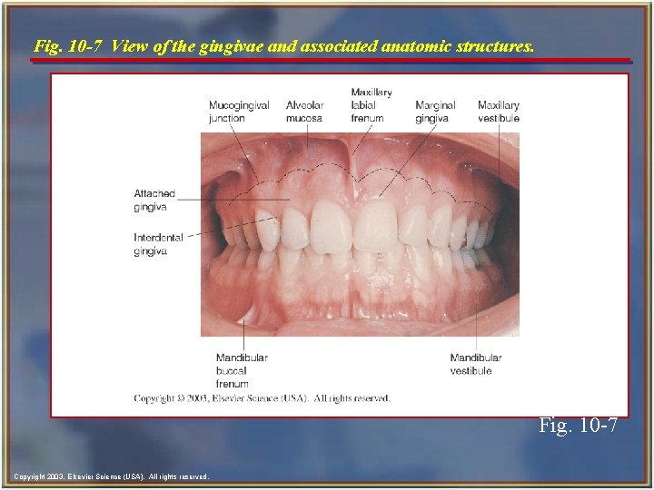 Fig. 10 -7 View of the gingivae and associated anatomic structures. Fig. 10 -7 Fig. 10 -7 View of the gingivae and associated anatomic structures. Fig. 10 -7