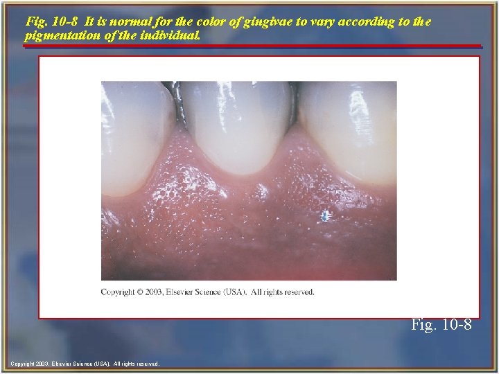 Fig. 10 -8 It is normal for the color of gingivae to vary according Fig. 10 -8 It is normal for the color of gingivae to vary according