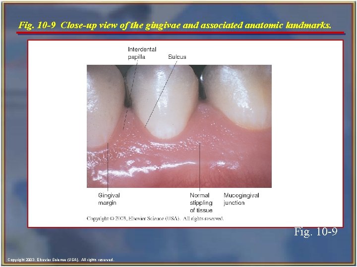 Fig. 10 -9 Close-up view of the gingivae and associated anatomic landmarks. Fig. 10 Fig. 10 -9 Close-up view of the gingivae and associated anatomic landmarks. Fig. 10
