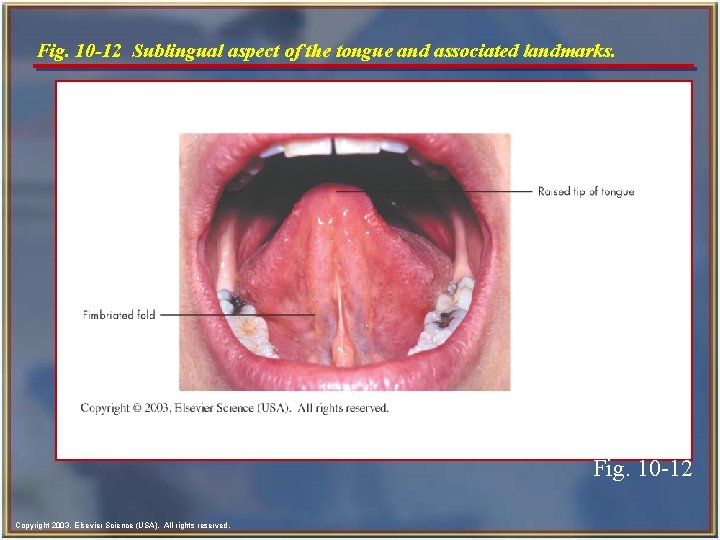 Fig. 10 -12 Sublingual aspect of the tongue and associated landmarks. Fig. 10 -12 Fig. 10 -12 Sublingual aspect of the tongue and associated landmarks. Fig. 10 -12