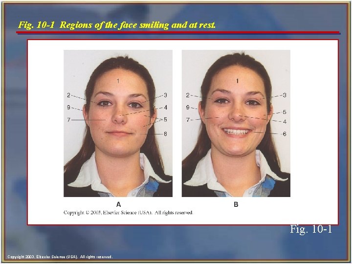 Fig. 10 -1 Regions of the face smiling and at rest. Fig. 10 -1 Fig. 10 -1 Regions of the face smiling and at rest. Fig. 10 -1