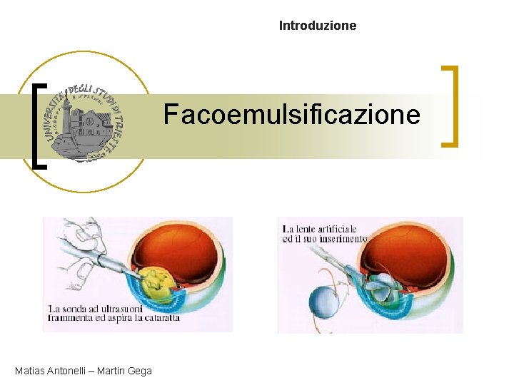 Introduzione Facoemulsificazione Matias Antonelli – Martin Gega 