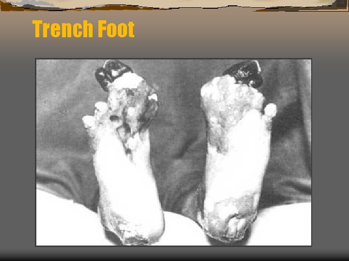 Trench Foot 