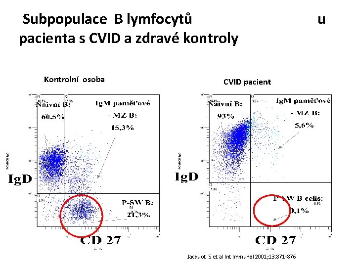 Subpopulace B lymfocytů pacienta s CVID a zdravé kontroly Kontrolní osoba CVID pacient Jacquot