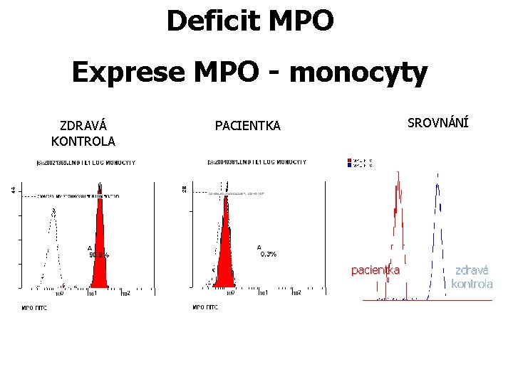 Deficit MPO Exprese MPO - monocyty ZDRAVÁ KONTROLA SROVNÁNÍ PACIENTKA pacientka zdravá kontrola 