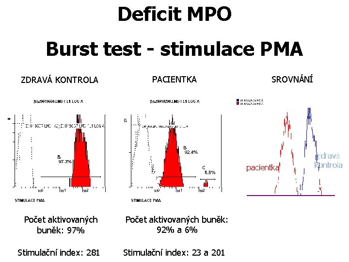 Deficit MPO Burst test - stimulace PMA ZDRAVÁ KONTROLA PACIENTKA SROVNÁNÍ pacientka Počet aktivovaných