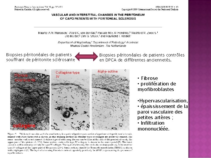 Biopsies péritonéales de patients souffrant de péritonite sclérosante Fibrose sclérosante collagène Collagène type IV