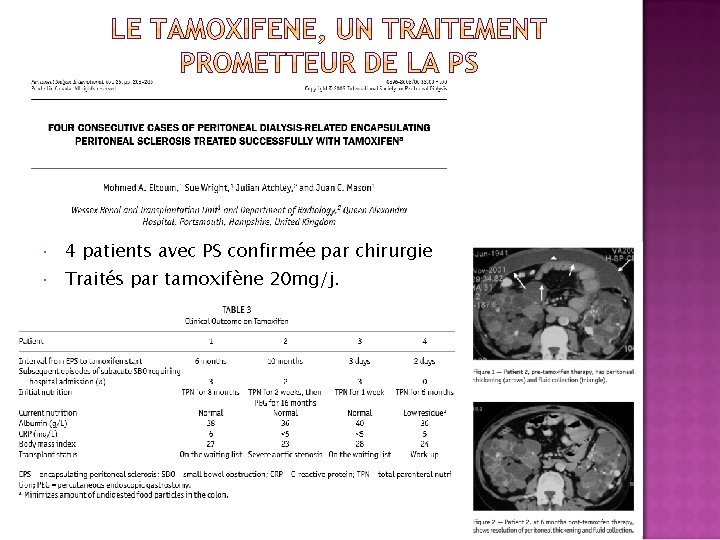  4 patients avec PS confirmée par chirurgie Traités par tamoxifène 20 mg/j. 