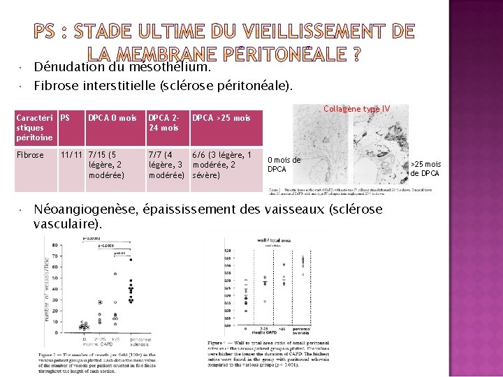  Dénudation du mésothélium. Fibrose interstitielle (sclérose péritonéale). Caractéri PS stiques péritoine Fibrose DPCA