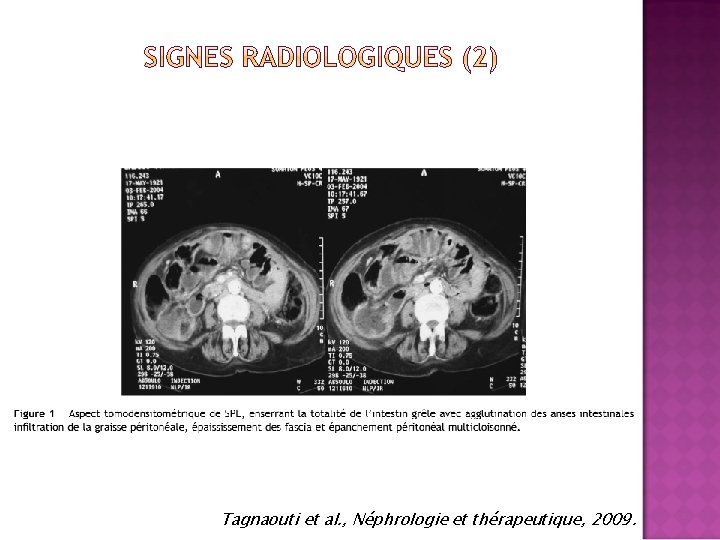 Tagnaouti et al. , Néphrologie et thérapeutique, 2009. 