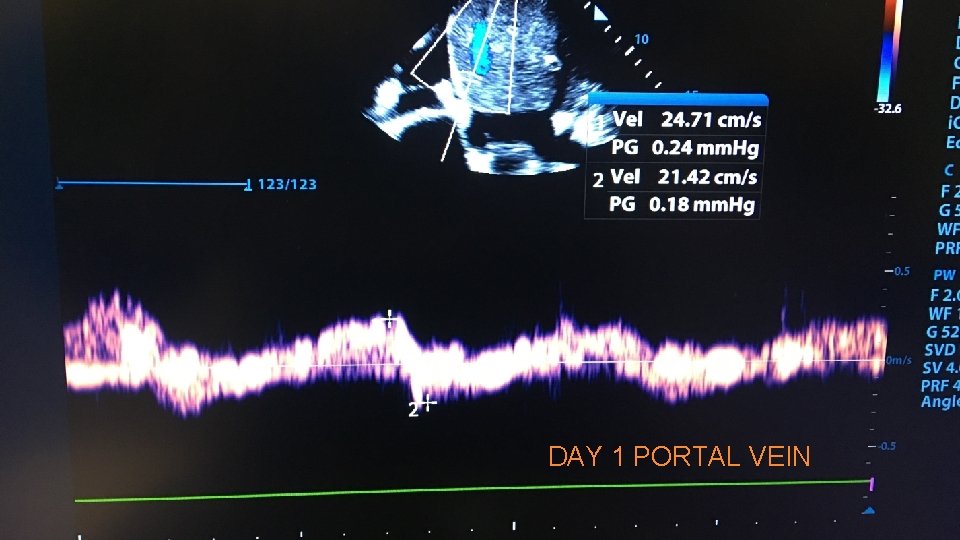DAY 1 PORTAL VEIN 
