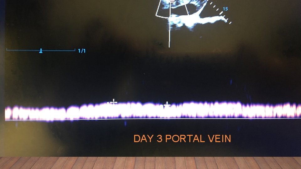 DAY 3 PORTAL VEIN 