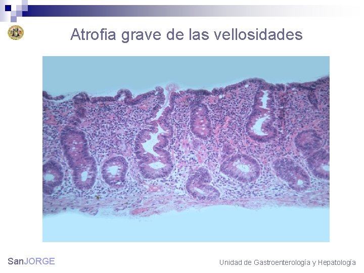 Atrofia grave de las vellosidades San. JORGE Unidad de Gastroenterología y Hepatología 