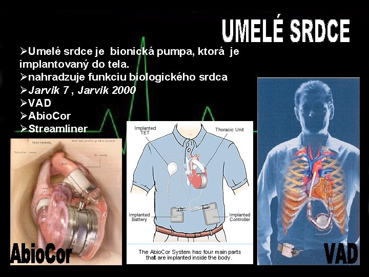 ØUmelé srdce je bionická pumpa, ktorá je implantovaný do tela. Ønahradzuje funkciu biologického srdca