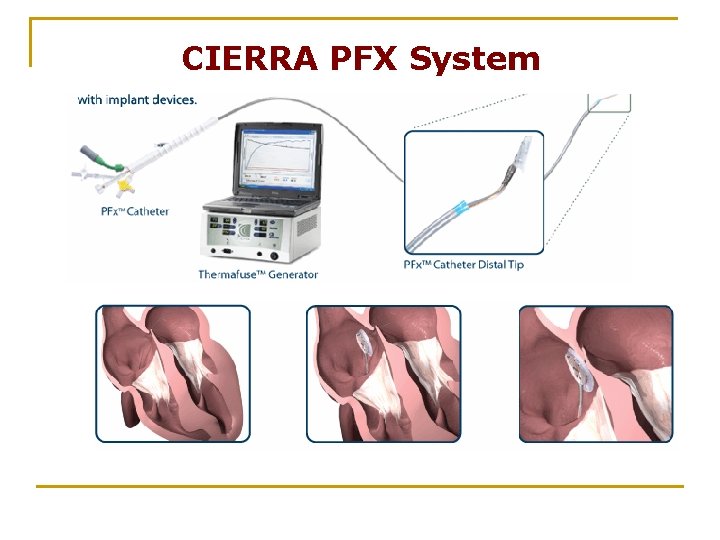 CIERRA PFX System 