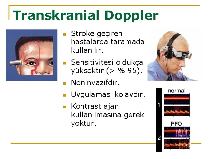Transkranial Doppler n n Stroke geçiren hastalarda taramada kullanılır. Sensitivitesi oldukça yüksektir (> %