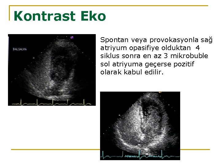 Kontrast Eko Spontan veya provokasyonla sağ atriyum opasifiye olduktan 4 siklus sonra en az