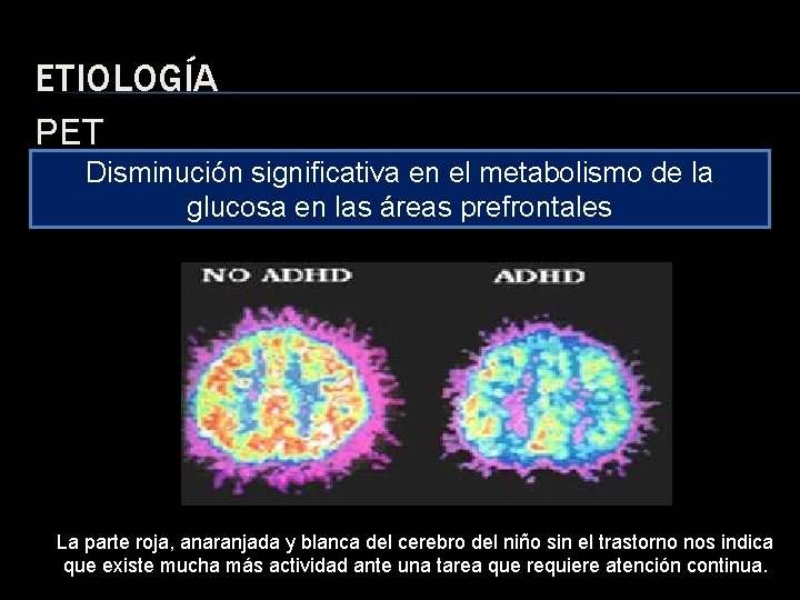 ETIOLOGÍA PET Disminución significativa en el metabolismo de la glucosa en las áreas prefrontales