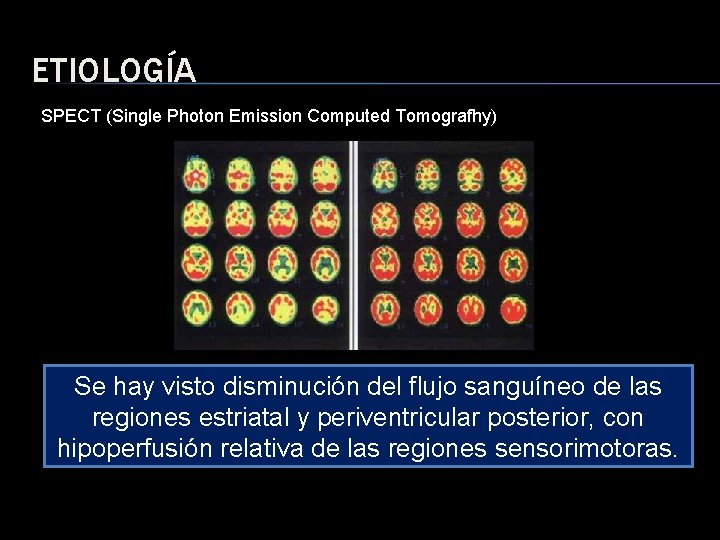 ETIOLOGÍA SPECT (Single Photon Emission Computed Tomografhy) Se hay visto disminución del flujo sanguíneo