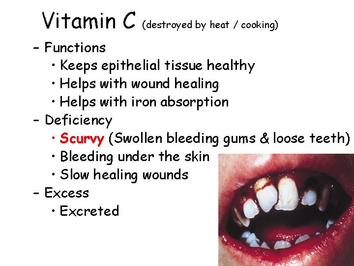 Vitamin C (destroyed by heat / cooking) – Functions • Keeps epithelial tissue healthy