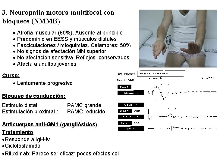 3. Neuropatia motora multifocal con bloqueos (NMMB) · Atrofia muscular (80%). Ausente al principio