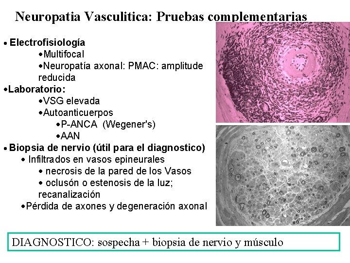 Neuropatia Vasculitica: Pruebas complementarias · Electrofisiología ·Multifocal ·Neuropatía axonal: PMAC: amplitude reducida ·Laboratorio: ·VSG