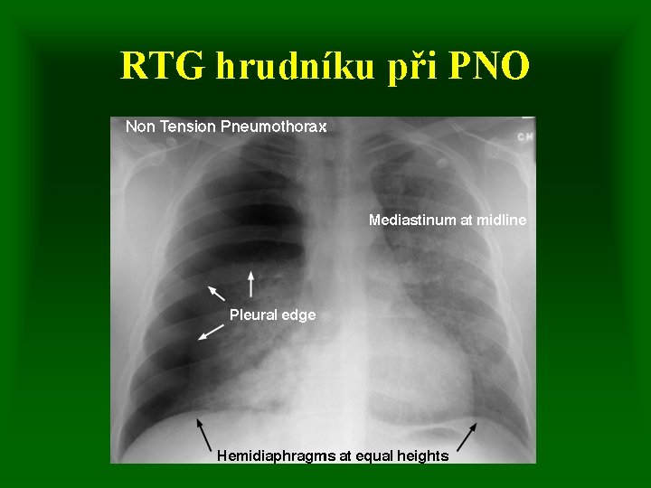 RTG hrudníku při PNO 