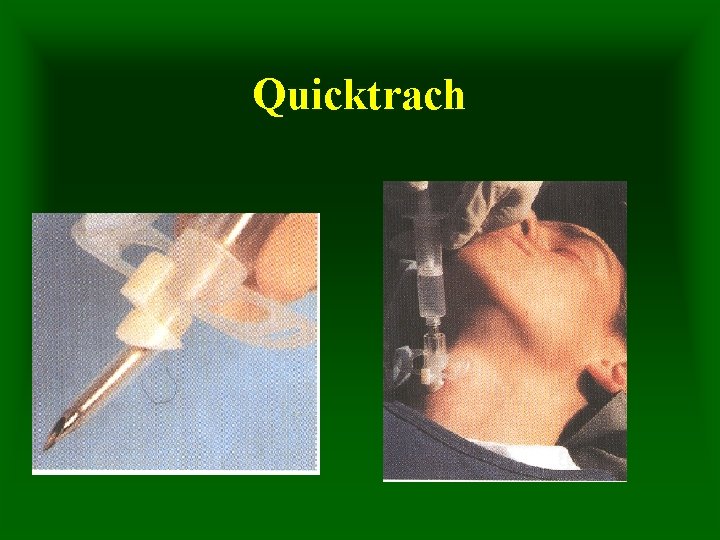 Quicktrach 