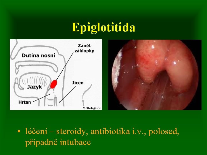 Epiglotitida • léčení – steroidy, antibiotika i. v. , polosed, případně intubace 