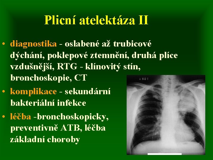 Plicní atelektáza II • diagnostika - oslabené až trubicové dýchání, poklepové ztemnění, druhá plíce