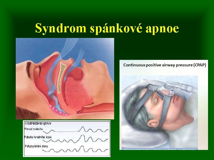 Syndrom spánkové apnoe 