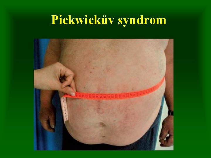 Pickwickův syndrom 