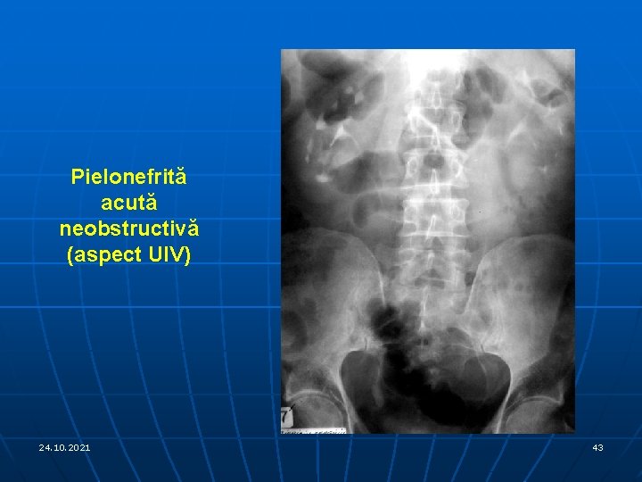 Pielonefrită acută neobstructivă (aspect UIV) 24. 10. 2021 43 