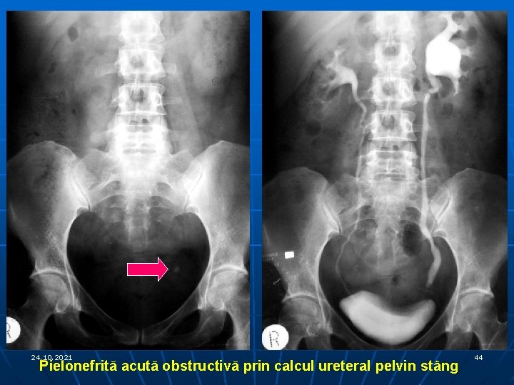 24. 10. 2021 Pielonefrită acută obstructivă prin calcul ureteral pelvin stâng 44 