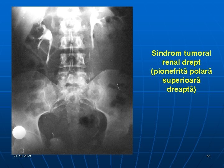 Sindrom tumoral renal drept (pionefrită polară superioară dreaptă) 24. 10. 2021 65 