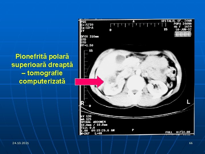 Pionefrită polară superioară dreaptă – tomografie computerizată 24. 10. 2021 66 
