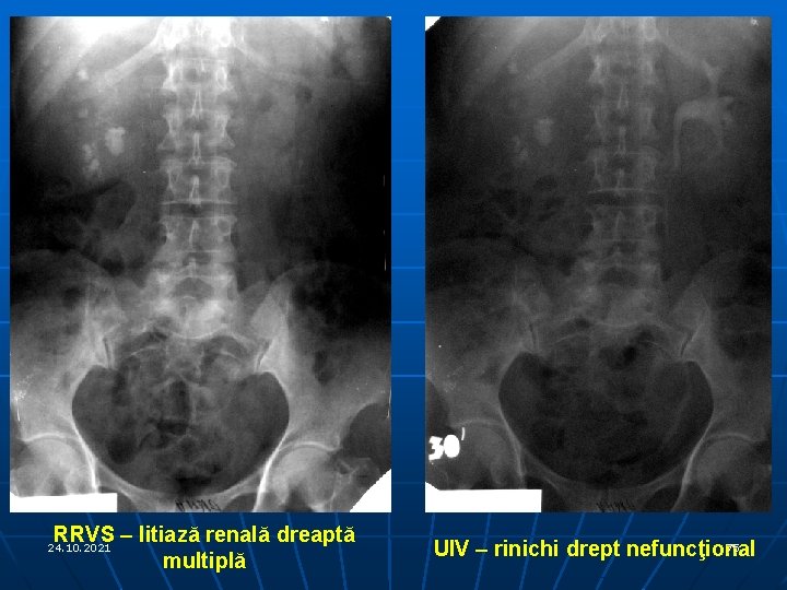 RRVS – litiază renală dreaptă multiplă 24. 10. 2021 75 UIV – rinichi drept