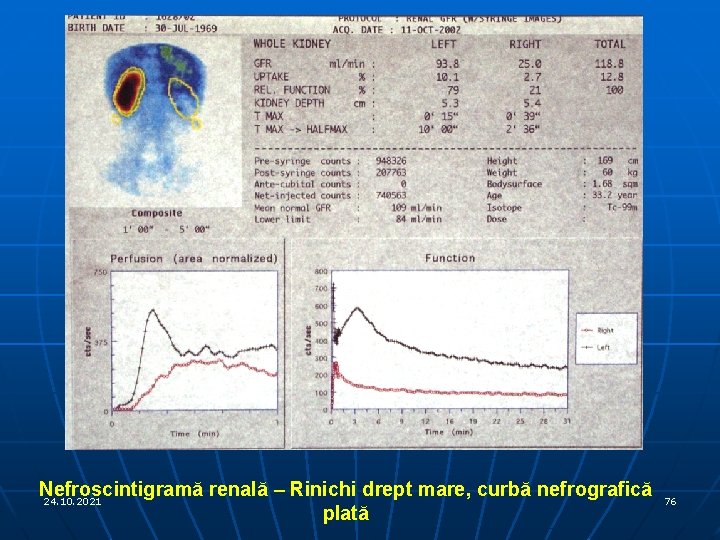 Nefroscintigramă renală – Rinichi drept mare, curbă nefrografică 24. 10. 2021 plată 76 