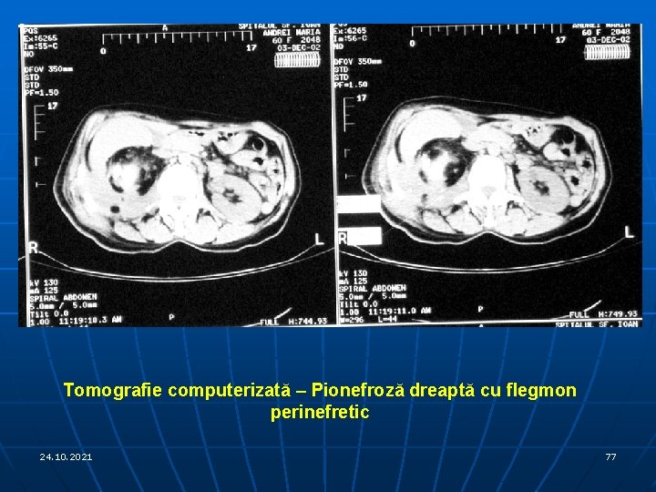 Tomografie computerizată – Pionefroză dreaptă cu flegmon perinefretic 24. 10. 2021 77 