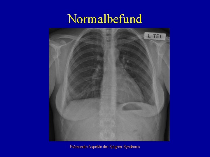 Normalbefund Pulmonale Aspekte des Sjögren-Syndroms 