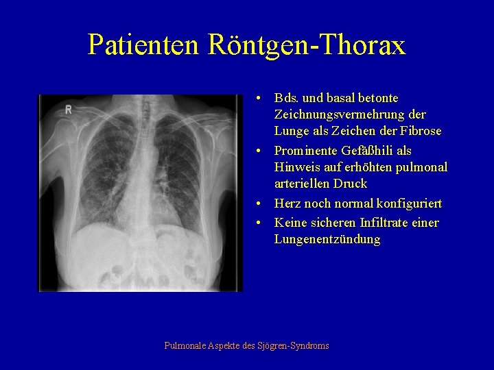 Patienten Röntgen-Thorax • Bds. und basal betonte Zeichnungsvermehrung der Lunge als Zeichen der Fibrose