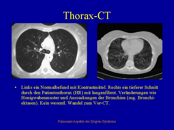 Thorax-CT • Links ein Normalbefund mit Kontrastmittel. Rechts ein tieferer Schnitt durch den Patiententhorax