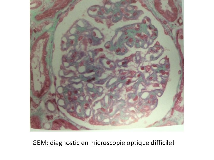 GEM: diagnostic en microscopie optique difficile! 