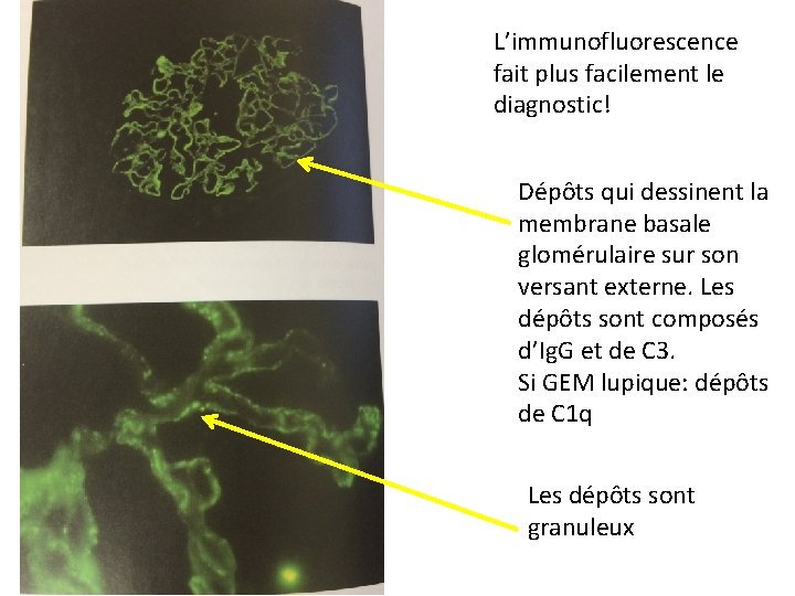 L’immunofluorescence fait plus facilement le diagnostic! Dépôts qui dessinent la membrane basale glomérulaire sur
