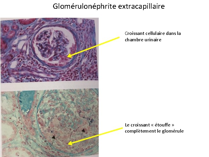 Glomérulonéphrite extracapillaire Croissant cellulaire dans la chambre urinaire Le croissant « étouffe » complètement